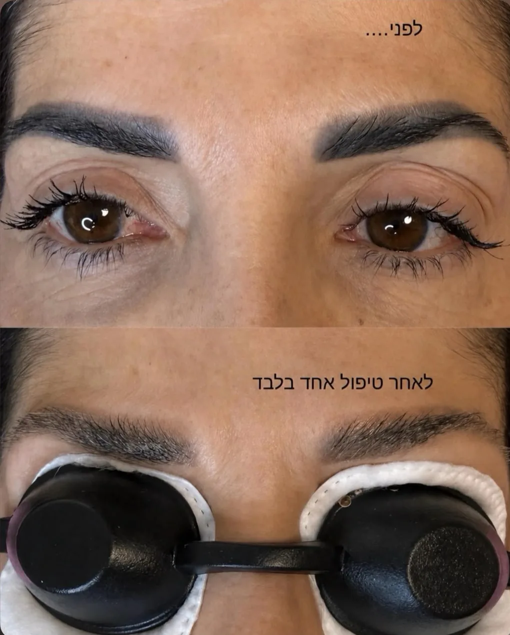 הסרה בלייזר